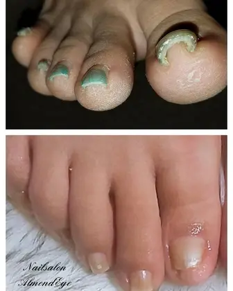 トラブルネイルケア 強力巻き爪に剥離 肥厚爪とトラブルネイルのお客様 巻き爪は痛 Nailsalon Almondeye所属 ネイルサロン Almondeyeのネイルデザイン ミニモ