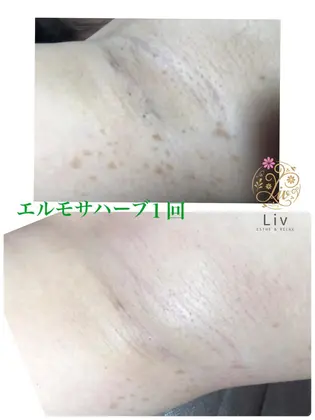 エルモサ脇ハーブ1回 くすみが取れて毛穴がキュッ 回数を重ねて魅せる脇に進化していきます Esthe Relax Liv所属 ひろおか ゆかりのエステ リラクカタログ ミニモ