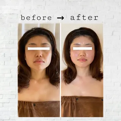 ほうれい線はや眉間のシワは消せます フェイスラインが変わるだけでお顔の印象が劇的に変化 マイナス サリーエミリー柏西口店所属 代表 神代 沙織のエステ リラクカタログ ミニモ