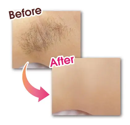 最新脱毛で 脇全体がスッキリ Aestheticsalon Bellelumiere ベル ルミエール イオンモール土浦店所属 ベルルミエール イオンモール土浦店のエステ リラクカタログ ミニモ