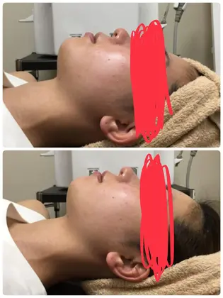 顔ビフォーアフター 二重アゴや頬肉の高さが変化しています 楽やせ美体研究所堀江店所属 Ren のエステ リラクカタログ 20180806110531 ミニモ