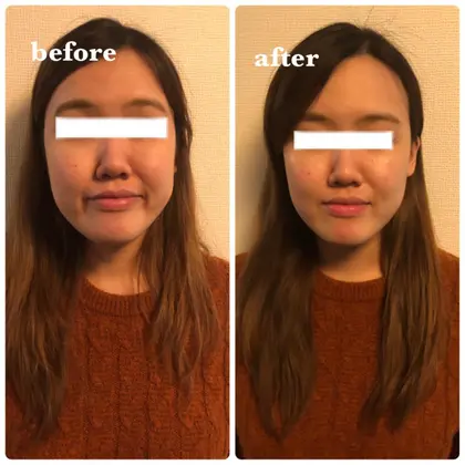 Risesalon所属 脱毛痩身エステハイフ ライズサロンyuriのメニュー ミニモ