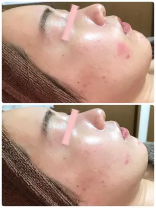 鼻周りの赤み クレンジング等で落としきれない皮脂が原因です 陶肌トリートメントは炎症にも効果があり ハーブ専門dioneさいたま店所属 佐藤 えみのエステ リラクカタログ ミニモ