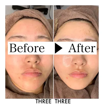 ハーブピーリングで赤みを消す Threethree所属 Threethree つつみのエステ リラクカタログ ミニモ