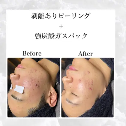 1521 韓国肌管理室 所属 韓国ピー リング専門店のエステ リラクカタログ ミニモ