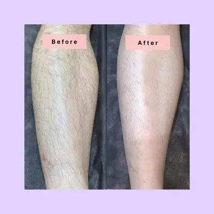 脇のプツプツザラザラ毛穴にも 美肌効果もございますので 黒ずみにも効果抜群 艶々毛穴レスの Private Salon Chloe クロエ 脱毛 フェイシャル所属 脱毛サロン Chloe クロエ のエステ リラクカタログ ミニモ