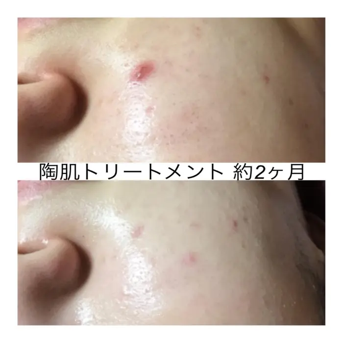 大きくできてしまったニキビ 色素沈着にならないよう できたらすぐハーブを入れ込むのが良いですよ ハーブ専門dioneさいたま店所属 佐藤 えみのエステ リラクカタログ ミニモ
