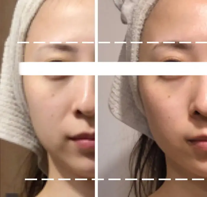 法令線 口元のもたつきがかなり薄くなりました Lara所属 La Raのエステ リラクカタログ ミニモ