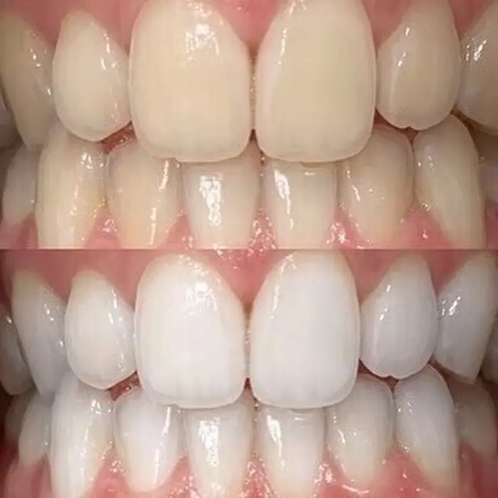 医療ホワイトニング