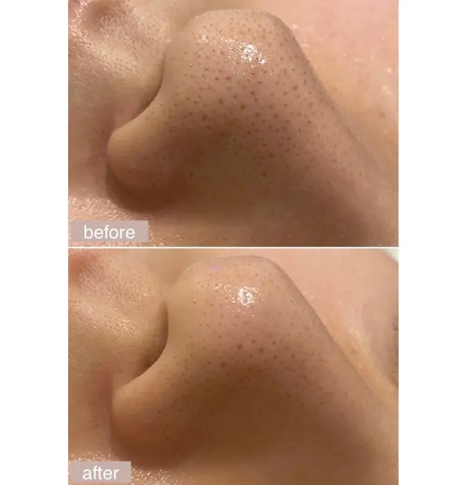 ハイドラフェイシャル1回のビフォーアフター毛穴の詰まり 角栓 黒ずみ解消 ニキビ予防 殺菌効果も Jerry所属 ハイフリフトアップ 大沼のエステ リラクカタログ ミニモ