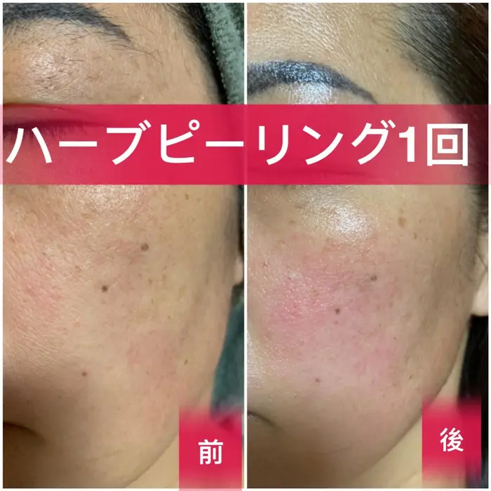 今話題のハーブピーリングお試し1g お顔の毛穴開きやアクネ菌 ニキビケア シミ改善 シワ改善な マノマノiida所属 越下 志穗子のエステ リラクカタログ ミニモ