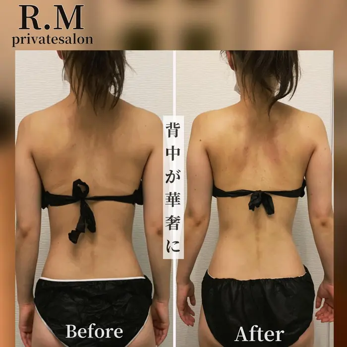 施術前後のお写真 肩周りを解して肩甲骨を内に 肩のラインも綺麗になりました R M所属 プライベートサロン R M アルム のエステ リラクカタログ ミニモ