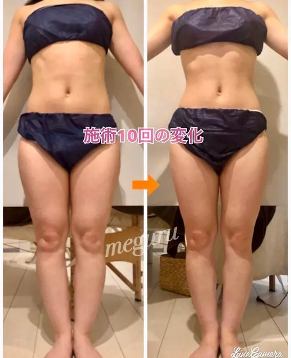本日のbefore After 約６ヶ月で10回来ていただいたお客様 目に見える変化 Meguru所属 痩身専門エステ 結果出し丹野のエステ リラクカタログ 20200415104011 ミニモ