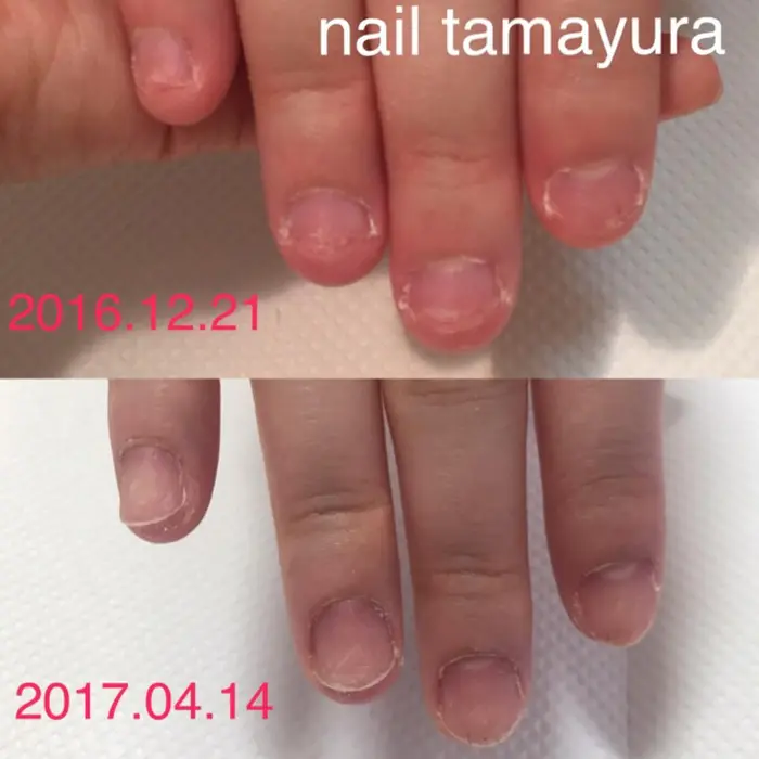 深爪矯正初回9800円 ネイルサロン カナン所属 Nailsalon Canaanのネイルデザイン ミニモ