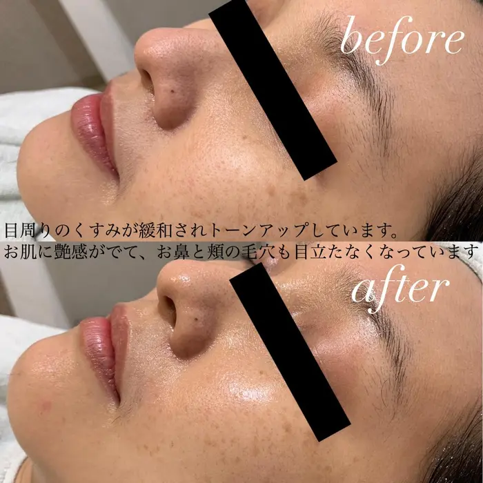 しみ くすみコース 目周りのくすみが緩和されお肌のトーンアップと 潤いを取り戻しました Trico高槻店所属 大薮 優里のエステ リラクカタログ ミニモ