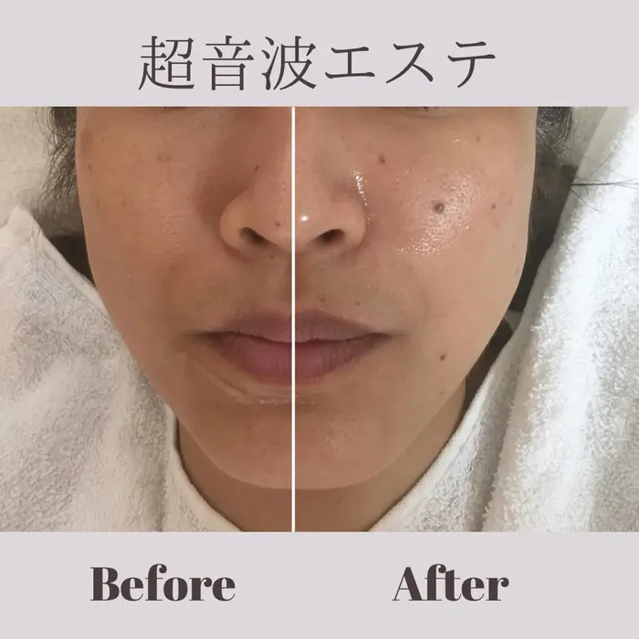 超音波エステで毛穴の一斉掃除 毛穴もキュッと小さくなり リフトアップ そして水分量アップでお肌も 小顔エステサロン マインドール所属 泉大津エステサロン マインドールのエステ リラクカタログ ミニモ
