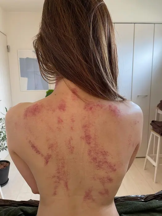 コリの強い部分はカッサ痕が強くでますが 施術を繰り返すうちカッサ痕は出にくい また出てもすぐに消失す Private Salon Charme所属 プライベートサロン シャルムのエステ リラクカタログ ミニモ コリの強い部分はカッサ痕が強くでますが 施術を繰り返すうちカッサ痕は出にくい また出てもすぐに消失す Private Salon Charme所属 プライベートサロン シャルムのエステ リラクカタログ ミニモ