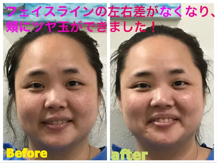 頬に左右差が出ていましたが 1回の施術で均等になりました 日頃の癖が原因なので 何回か施術をしていけ 本厚木整骨院所属 本厚木整骨院 フェイシャル 美顔鍼のエステ リラクカタログ ミニモ