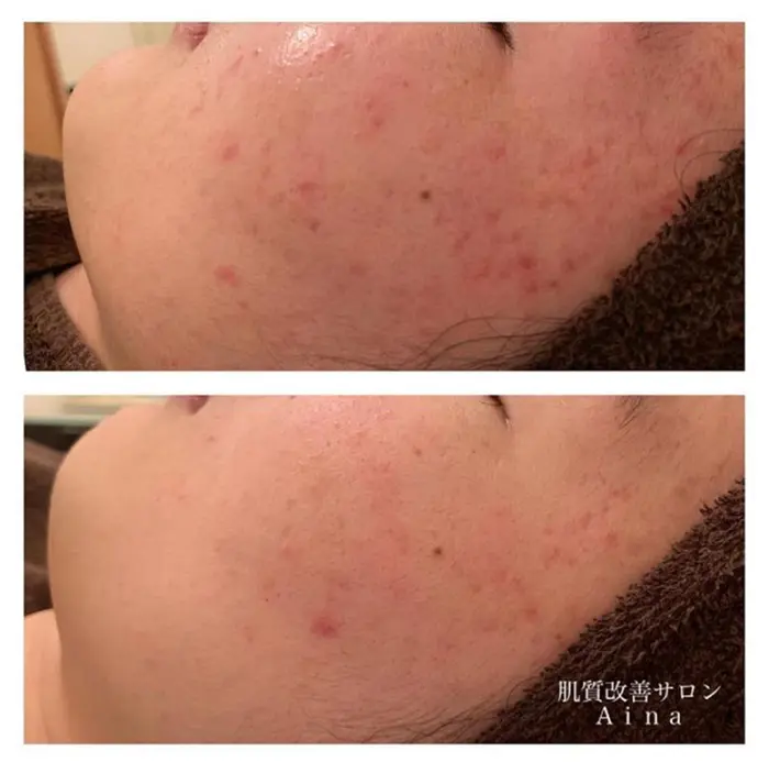 周りから褒められる肌に ４ヶ月 ７回 何をしてもニキビが治らない とご来店いただきました ニキビ ニキビ跡専門サロンａｉｎａ所属 ニキビ改善サロン 益子早百合のエステ リラクカタログ ミニモ