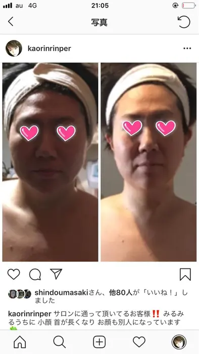 痩身ジェルフェイシャル 7回 小顔を目指し頑張ってます エステティックサロン華々所属 福島 かおりのエステ リラクカタログ ミニモ