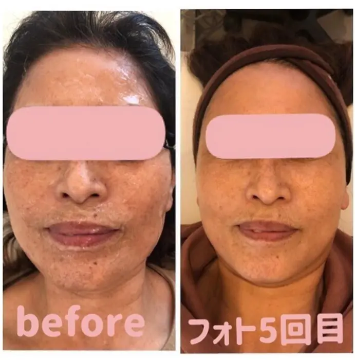 60代お客様 元々多いそばかすと シミにお悩みでした 前回まで4回のフォトフェイシャル Karibu Hair Relax所属 Karibu Hair Relaxのエステ リラクカタログ ミニモ