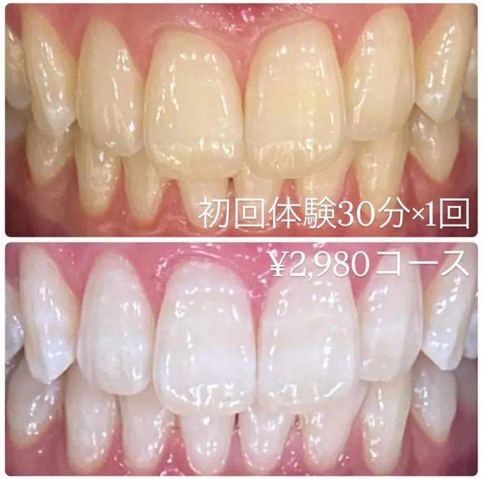 
 #ホワイトニング横浜 #セルフホワイトニング横浜   #横浜ホワイトニ?...