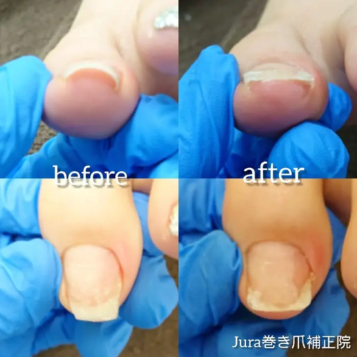 巻き爪補正 Jura巻き爪補正院所属 小椋 正樹のネイルデザイン ミニモ