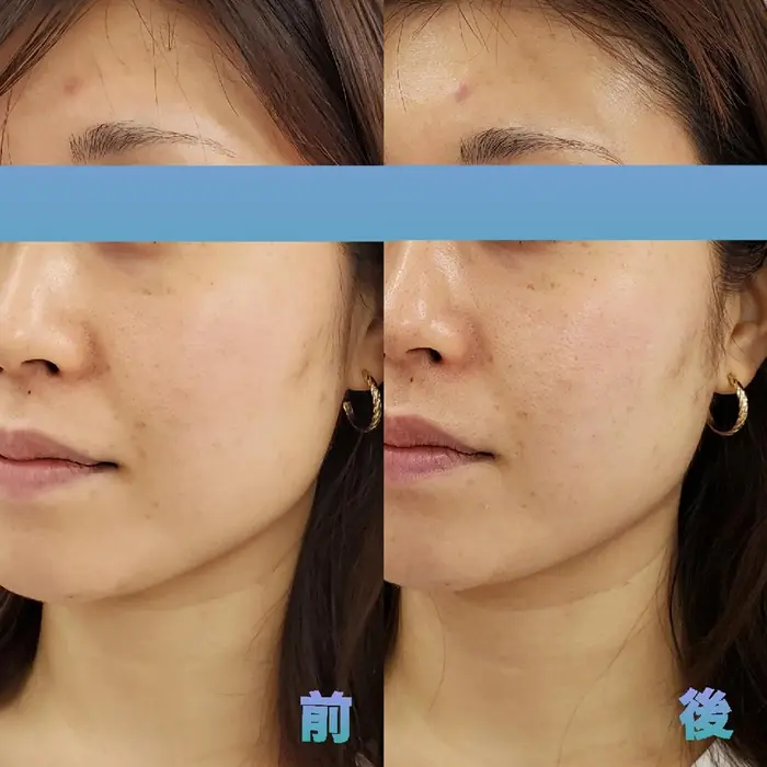 頬が上がり面積が狭くなりました リンパマッサージでたるみがupしました Srsalon Lino所属 Srsalon Linoのエステ リラクカタログ ミニモ