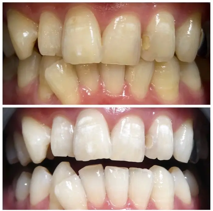 プレミアムホワイトニング〈医療〉です！
最短３日で完了
結婚式、行事?...