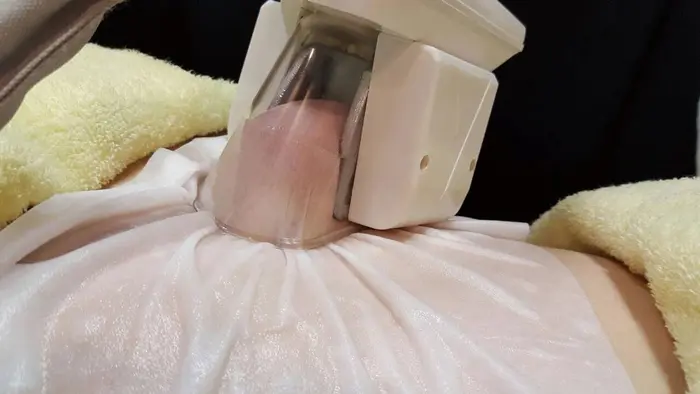 脂肪冷却 Rayvis仙台店所属 エステティック レイビス仙台店のエステ リラクカタログ ミニモ