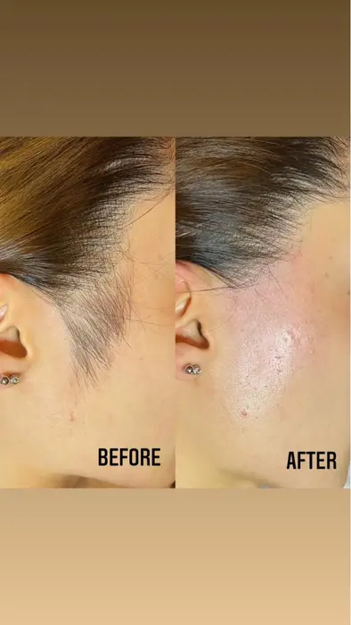 もみあげwax脱毛 光脱毛 脱毛サロン９nine所属 脱毛サロン ９ Nine 川崎のエステ リラクカタログ ミニモ