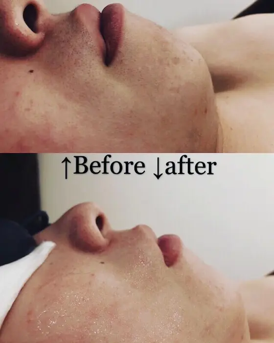 薄いウブ毛まで取ってくれるうららの脱毛 お顔の肌トーンもかわります 美肌効果もある顔脱毛は大人気です お肌の弱い方 脱毛専門サロンurara 麗ら 所属 うらら 奥田 るかのヘアカタログ ミニモ