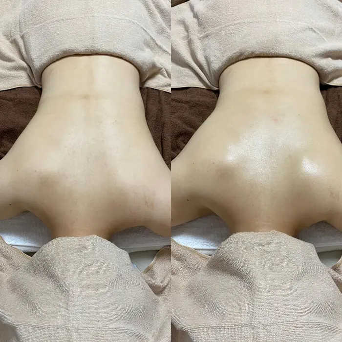 背中リンパマッサージ１回施術で肩甲骨 天使の羽 がキレイに出ました Fleurir所属 米村 ゆかのヘアカタログ ミニモ