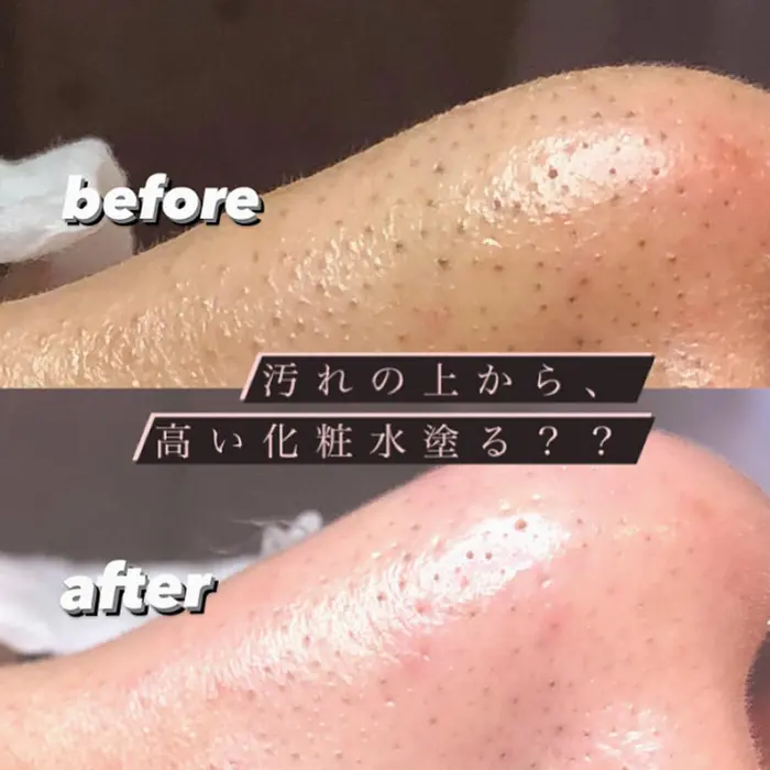 エクストラクションビフォーアフター 毛穴エクストラクション専門gypsophila15 所属 いちご鼻一撃 Yonのエステ リラクカタログ ミニモ