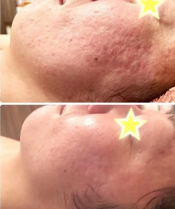 アコライム化粧品3カ月使用 ヒト幹細胞 植物幹細胞 クィーンフィトセルフェイシャル4回の変化 Umiere所属 吉田 佳菜子のエステ リラクカタログ ミニモ