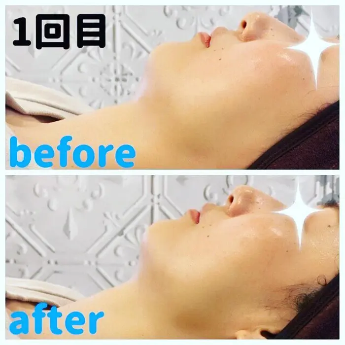 ハイフ体験モニターのお客様 アゴ下のもたつきと元々気にされていた左右差が軽減したと実感してい Karibu Hair Relax所属 Karibu Hair Relaxのエステ リラクカタログ ミニモ