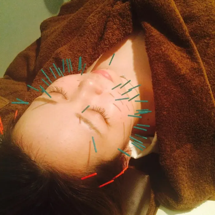 サボテン美顔鍼灸 アネモネ心斎橋所属 美容鍼サロン アネモネ心斎橋のエステ リラクカタログ ミニモ