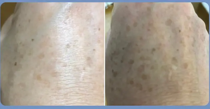 ヒアルロン酸 コラーゲンイオン導入 美白脱毛での効果です お客様に写真をご提供していただきました Arona アローナ 所属 Nori のエステ リラクカタログ ミニモ