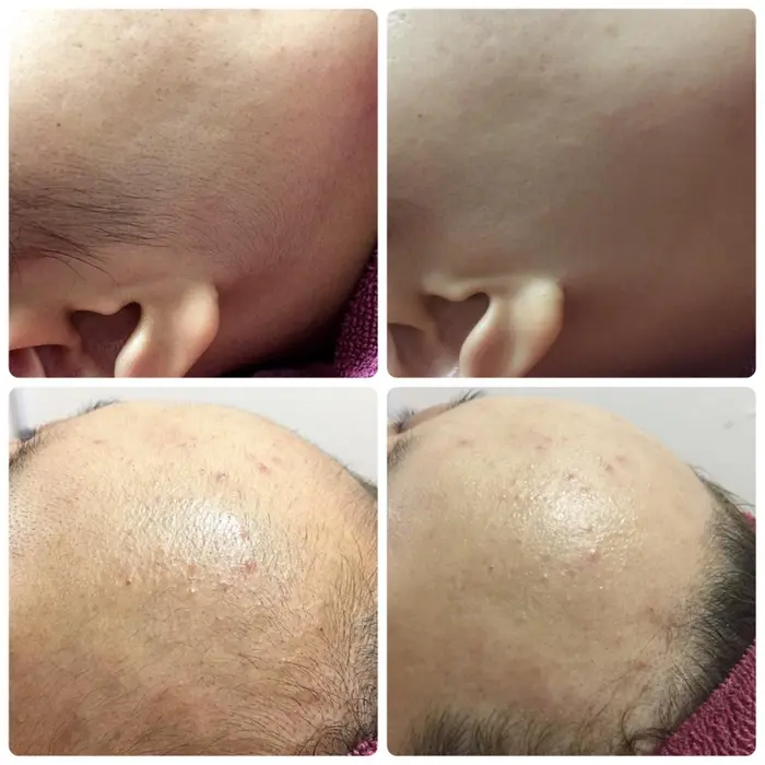 顔周りの毛が生えていると より一層くすんで見え肌の印象がかなり変わります 額やもみあげなど顔周りを ナチュラルリアンジェ所属 ナチュラル リアンジェのエステ リラクカタログ ミニモ