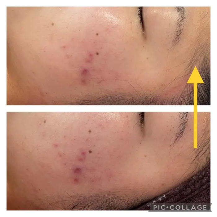 炎症ニキビは シンプルに スキンケア用品もおすすめします 毛穴 くすみ専門店hagukumu はぐくむ 所属 Hagukumu はぐくむ のエステ リラクカタログ ミニモ