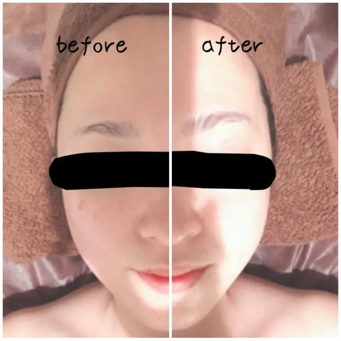 小顔コースでの効果例 この写真はたった10分のお手入れの差 Beforeの左に比べ Lful Beauty Salon所属 Lful ルフール エステ 多田のエステ リラクカタログ ミニモ