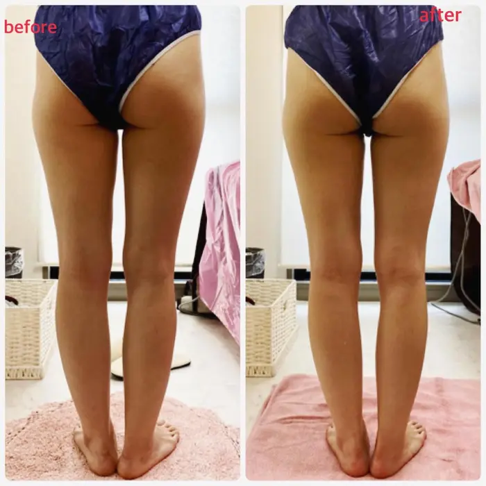 キャビテーション 太もも表裏 筋膜リンパマッサージ 下半身 一度の施術のビフォー Perla Esthetic Salon所属 プライベートサロン Perlaのエステ リラクカタログ ミニモ