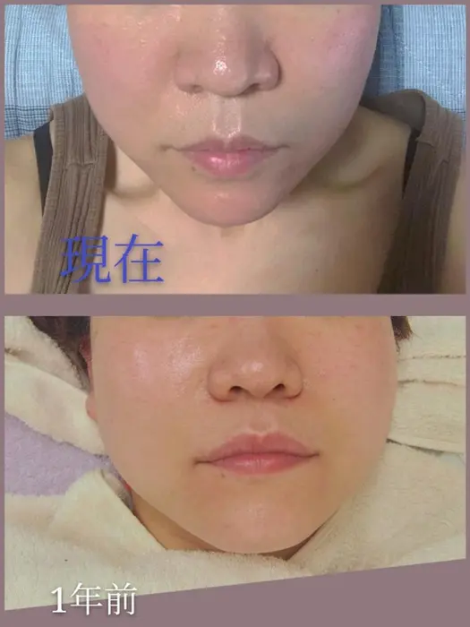 定期的なケアで小顔にも 毛穴の大きさも くすみも むくみ 新しいハーブトリートメ Guzel Salon所属 Guzel Safのエステ リラクカタログ ミニモ