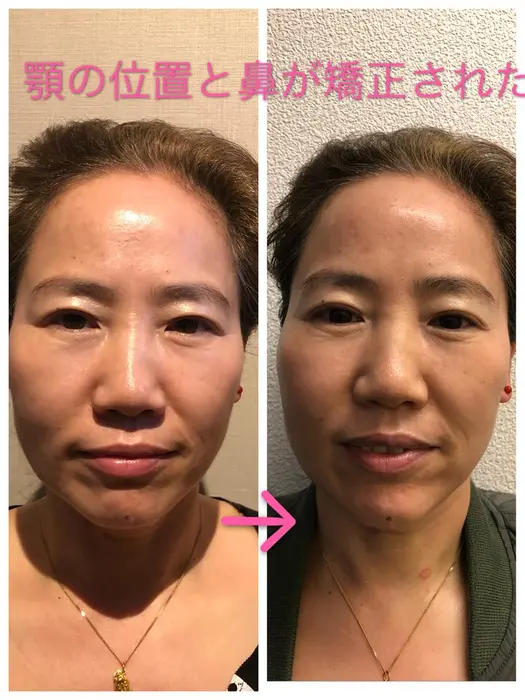 鼻の矯正 骨格矯正 整体所沢所属 でやま りゅうのエステ リラクカタログ ミニモ