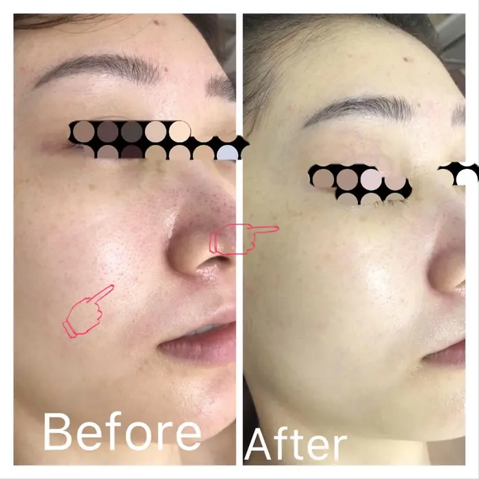 若々しい23歳 でも荒れてて炎症まで起こしてるトラブル肌 一回の施術でご覧の通りに変わりました 引き ハイパーナイフ痩身 小顔コルギ ハーブピーリング K Beauty 東新宿所属 さいとう かずみのエステ リラクカタログ ミニモ