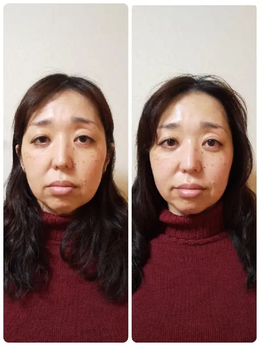 一度の施術でこの効果 目がぱっちり大きくなり 口元のもたつきがなくなり口角もあがっていますね Tanoayu タノアユ 所属 骨格調律師 川原範このエステ リラクカタログ ミニモ