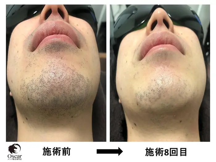 Oscar オスカー メンズ脱毛名古屋 髭 ヒゲ脱毛 男性脱毛 Vio脱毛 全身脱毛 永久脱毛 光脱 メンズ脱毛専門店oscar オスカー 所属 渡辺 裕之 脱毛技能士 のエステ リラクカタログ ミニモ
