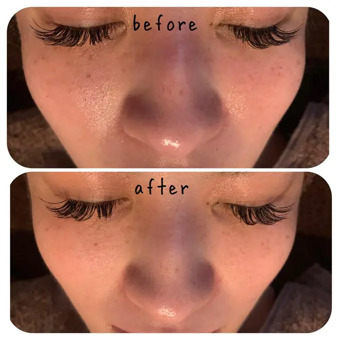 一度の施術でお肌の赤みがなくなり毛穴の黒ずみが改善されました 継続することで改善につながります Diane所属 Kobori Taeのエステ リラクカタログ ミニモ