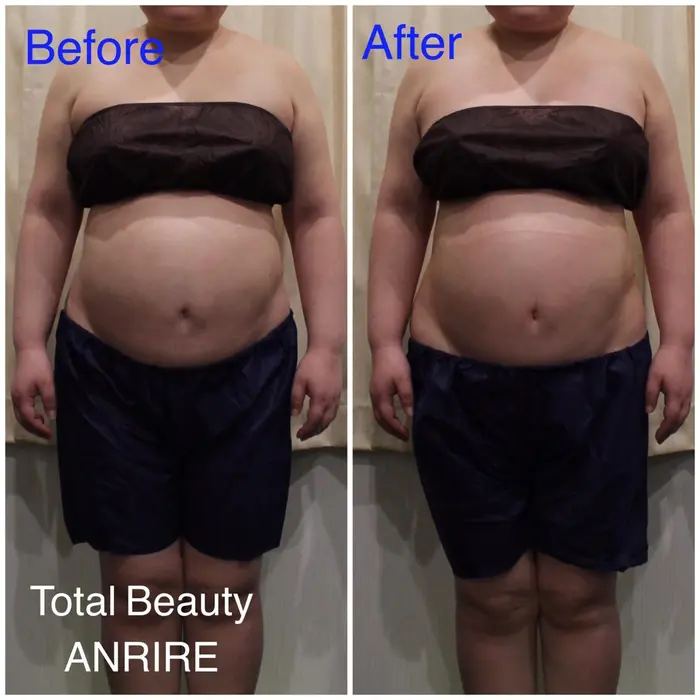 上半身にwinbackラジオ波をかけました トータルビューティanrire所属 トータルビューティ Anrireのエステ リラクカタログ ミニモ