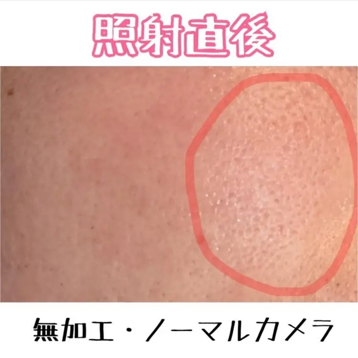q脱毛すると毛穴が目立たなくなるって本当 a本当です 毛穴が小さくなり 目立たなくなりますこちら ビューティーサロンstyle 広島店所属 ビューティーサロン Style 広島店のエステ リラクカタログ ミニモ q脱毛すると毛穴が目立たなくなるって本当 a本当です 毛穴が小さくなり 目立たなくなりますこちら ビューティーサロンstyle 広島店所属 ビューティーサロン Style 広島店のエステ リラクカタログ ミニモ